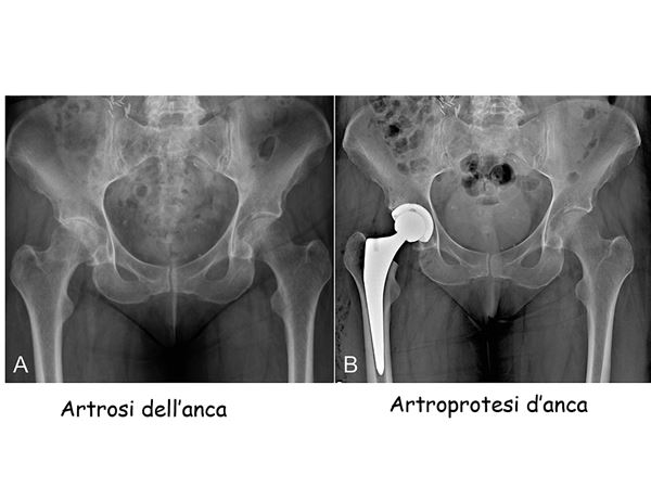 artrosi anca