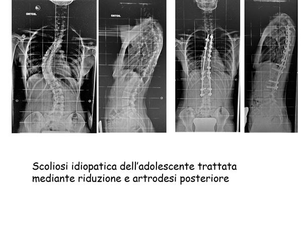 Trattementi della colonna vertebrale