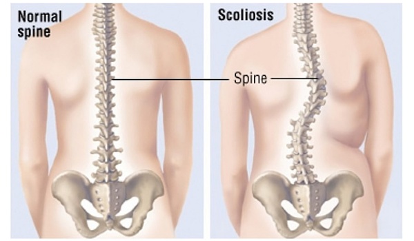 Scoliosi