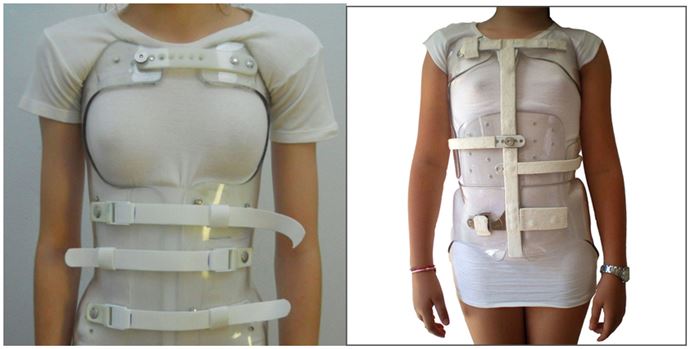Tutore per la scoliosi